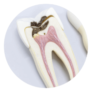 Leczenie kanałowe zębów.