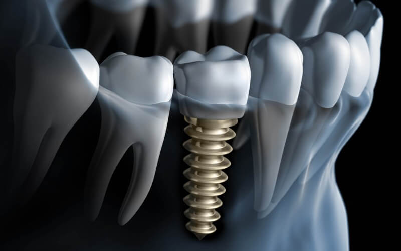 Implanty zębowe – kompendium wiedzy